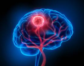 Drug developer Servier's brain cancer drug slows tumor progession considerably