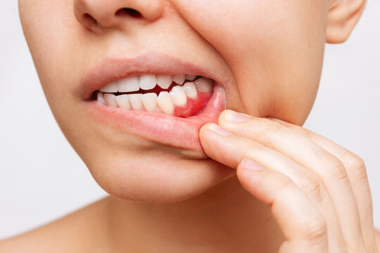 Scientists discover a new way to prevent gum disease without killing good bacteria: Study
