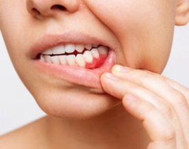 Scientists discover a new way to prevent gum disease without killing good bacteria: Study