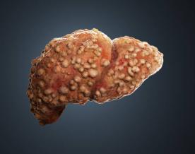 Study finds treatment identified for liver fibrosis