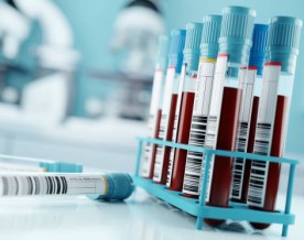 Study of blood samples reveal biomarkers, may help develop blood test for chronic fatigue syndrome