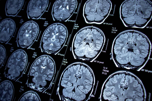 Non-invasive treatment for brain tumours unveiled, to ensure faster recovery 