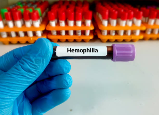 Experts urge standard treatment guidelines to streamline haemophilia care in India