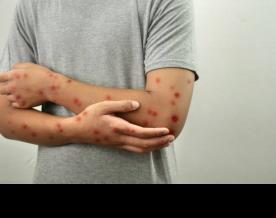 Govt asks states to identify facilities, trained human resources to handle mpox cases