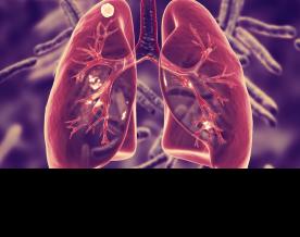 Nutrition support shown to prevent TB, related deaths in India: Lancet study