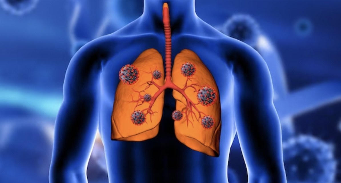 Childhood bronchitis, pneumonia linked with higher death risk from respiratory infection as adult: Lancet Study