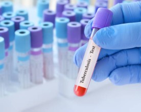 India accelerates battle against tuberculosis with homegrown diagnostic breakthroughs